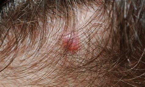 Lump Under Skin On Scalp at Jorge Maxwell blog
