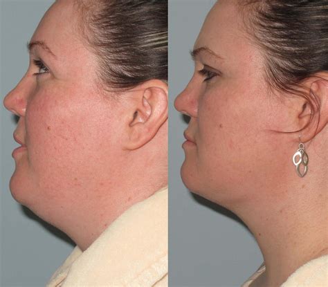 Double Chin Fat Removal Sydney | Fotona Tightsculpting Sydney