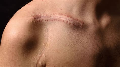 Understanding and Treating Scar Sensitivity: Itching, Pain & Nerve Iss ...