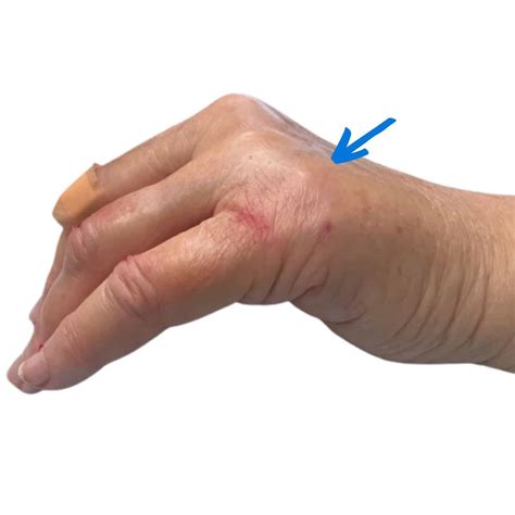 Boxer's Fracture - MD West One