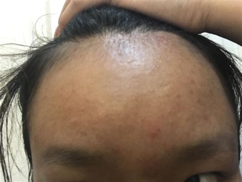 Small Bumps on Forehead – Acne – Acne.org Forum