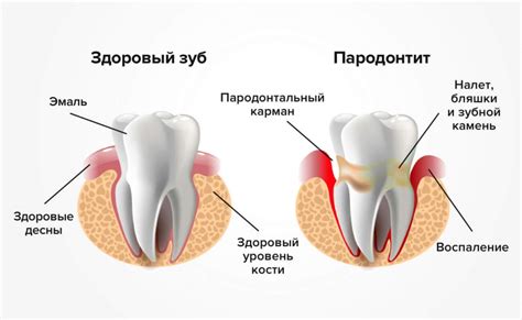 Лечение пародонтита в Москве - от 1200 рублей, симптомы и методы ...