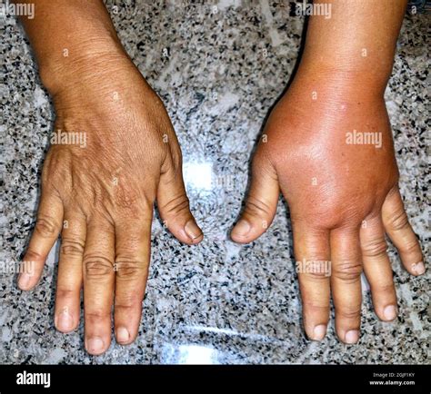 What Causes Swelling In The Right Arm at Debra Masters blog