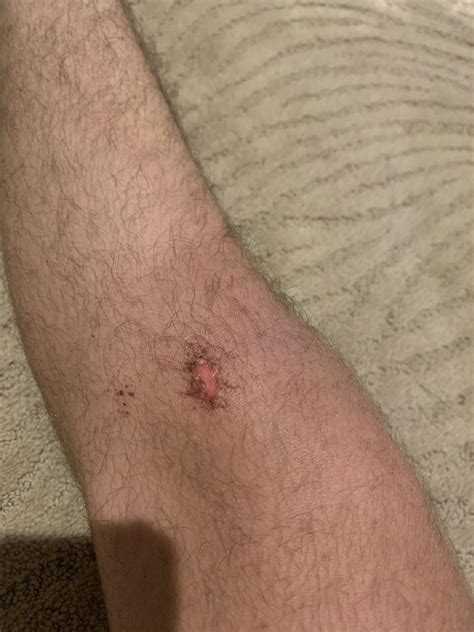 Turf Burns/ diving form : r/GoalKeepers