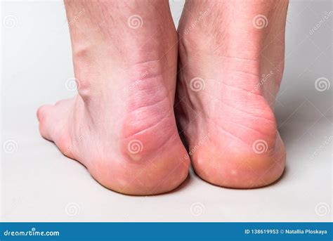 Knot On Back Of Heel