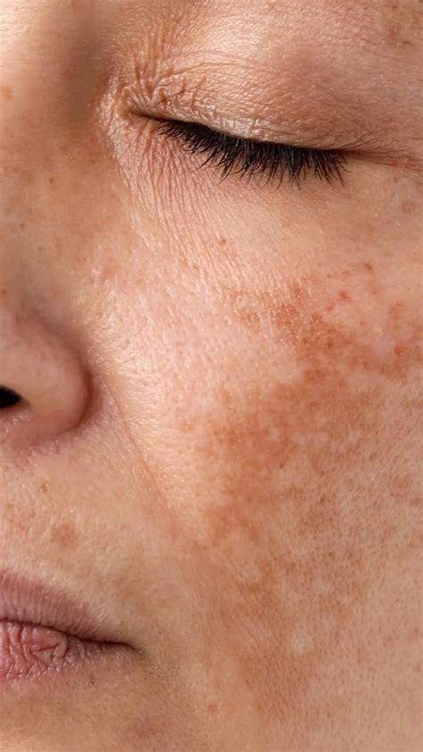 8 Common Skin Problems and How to Fix Them | Skin problems, Dark spots on face, Spots on face