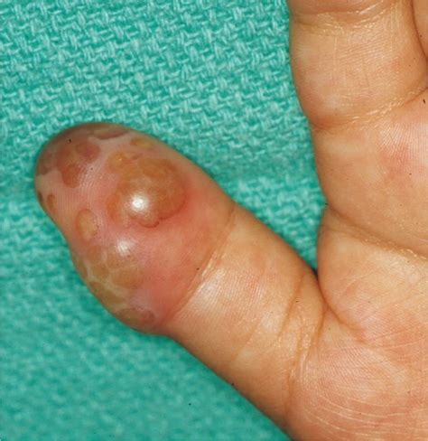 Herpes, causes, signs, symptoms, diagnosis, treatment & prognosis