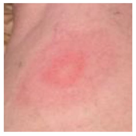 Presentation of Acrodermatitis Chronica Atrophicans Rashes on Lyme ...