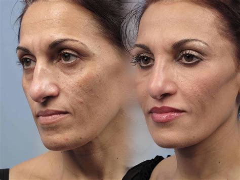 Laser Resurfacing Treatment Cost at Katrina Bates blog