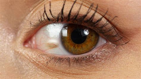 Pinguecula vs Pterygium: Harley Street Eye Clinic Guide