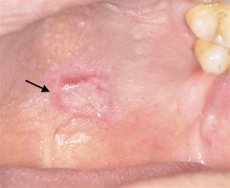 What Does A Burned Palate Look Like at Roger Pettigrew blog