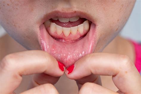 How to Reverse Gum Recession | Teeth Cleaning | TX