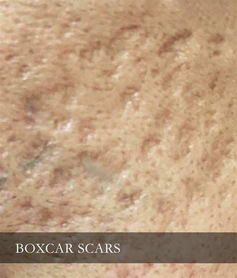 Box Scar Best Treatment at Edward Call blog