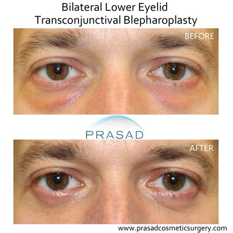 Can Eye Bag Surgery Go Wrong? | Dr. Prasad Blog