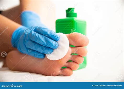 Surgical Removal Of Pyogenic Granuloma On Skin Royalty-Free Stock Photography | CartoonDealer ...