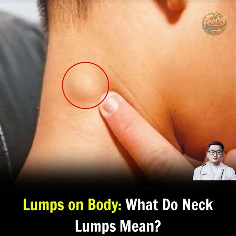 Lumps on Body: What Do Neck Lumps Mean?