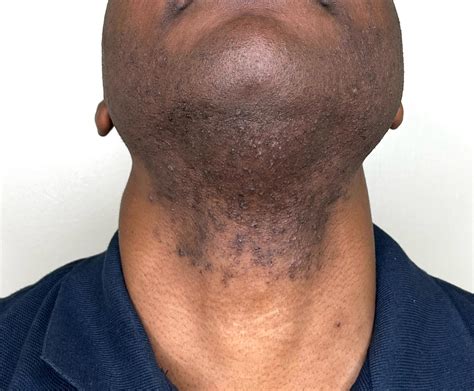 How To Prevent Ingrown Hairs