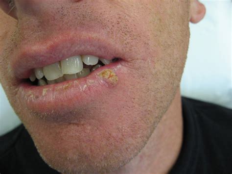 Lip Warts Images at Willa Gullett blog