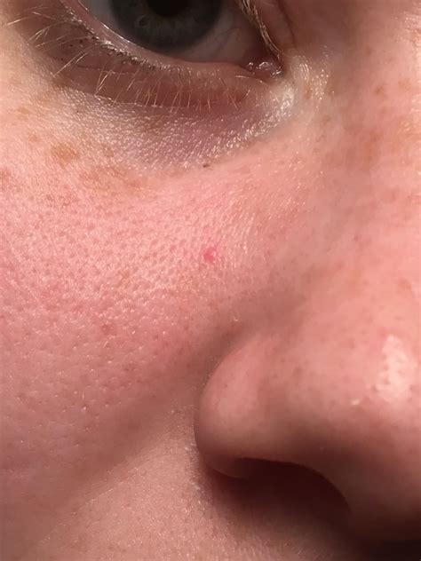 What are pinpoint red spots on skin - frosdgift