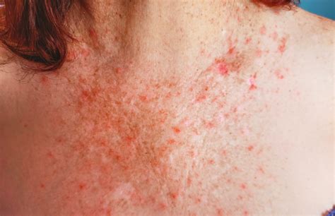 West Nile virus is on the rise: What Texans need to know | Brain | Dermatology | Prevention | UT ...