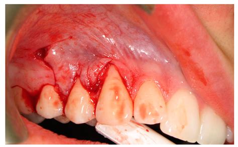 Laterally Positioned Flap Procedure with Augmented or Nonaugmented ...