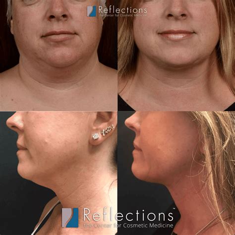 Skinny Lipo Of Neck Of Chin With Laser