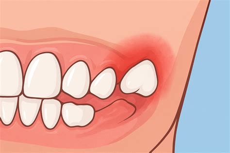 Swollen Gums Around Wisdom Teeth: Is This Normal or a Problem?