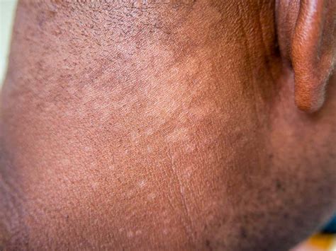 Small Fungus Spots On Skin And Hair - Infoupdate.org