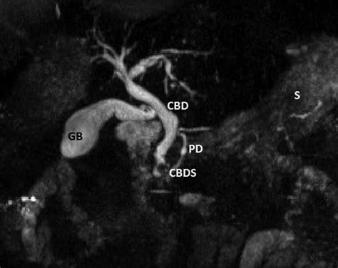 Complicated bile duct stones | BMJ Case Reports