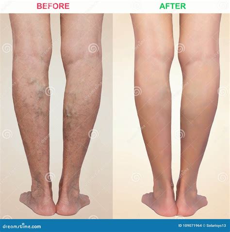 Tratamiento De Varicoso Antes Y Después Varices En Las Piernas Foto de archivo - Imagen de salud ...