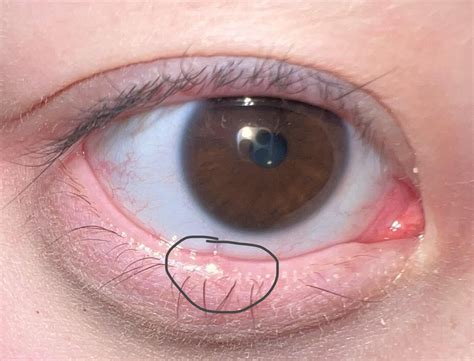 small bump on lower waterline : r/DermatologyQuestions