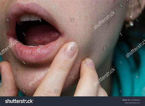 Cold Sores Corner Of Mouth