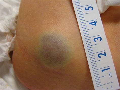 Baby Red Bumps On Buttocks at Rose Briggs blog