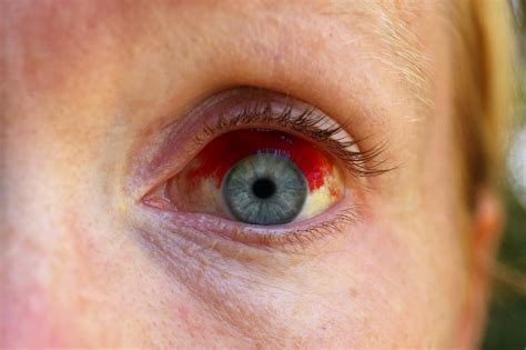 Subconjunctival hemorrhage (broken blood vessel in eye)