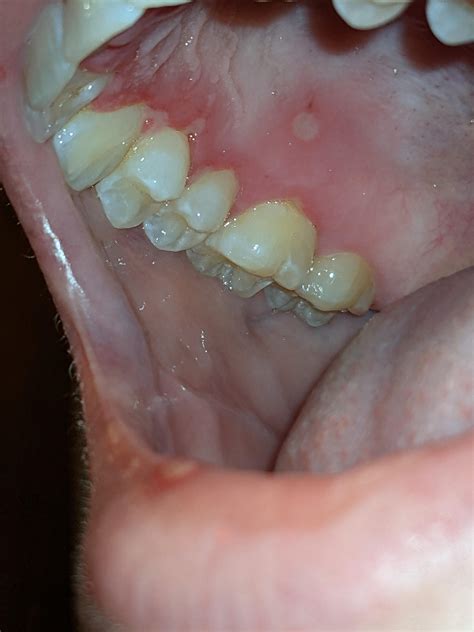Herpes Simplex Stomatitis