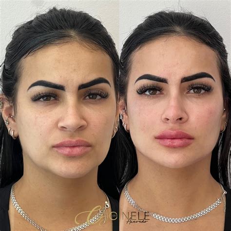 Dra Cinele Azevedo | Harmonização Facial RJ | A Grazi é uma paciente mega especial, me procurou ...