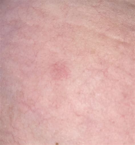 Red spots on breast? Help! : r/bigboobproblems