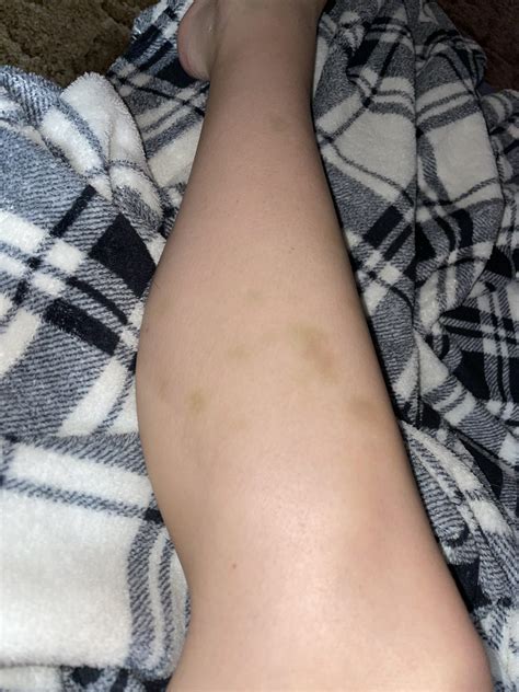 Iron Deficiency Anemia Bruising