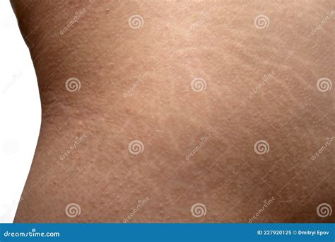 Stretch Marks on Woman& X27;s Buttocks Skin Stock Image - Image of slimming, cellulite: 227920125