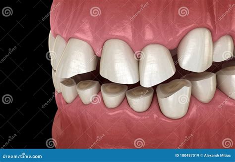 Attrition Treatment Comparison Illustration Vector On Blue Background ...