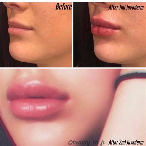 Lip Filler Before And After 1 Syringe | Before And After