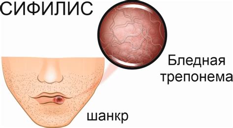 Сифилис: симптомы, признаки, как передается, виды, проявления, лечение