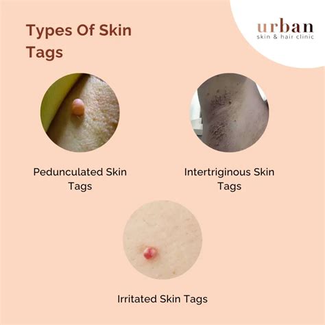 Medical Name For Skin Tag at David Morant blog