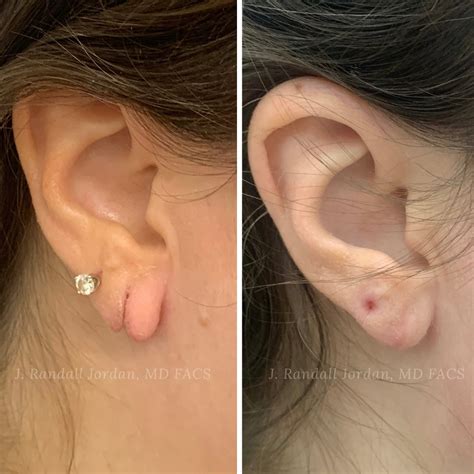 Stretched Earlobe Repair Surgery Following Gauge Earring Expert Split