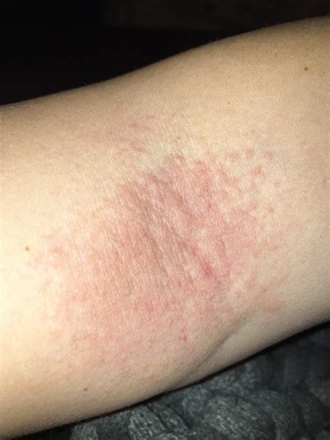 Developing a rash on my arm (inside part, where it bends). I put ...