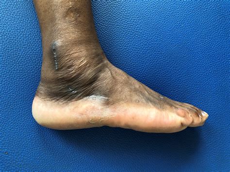 Peroneal Muscle Tear