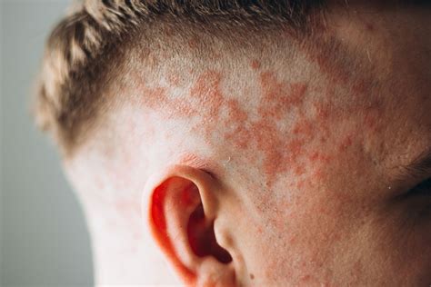 Eczema On Baby Scalp