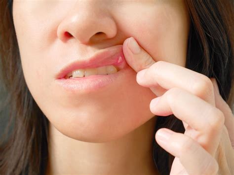 Cold Sore Or Pimple Corner Of Mouth