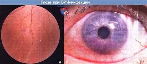 Изменения глаз при ВИЧ и СПИДе у детей
