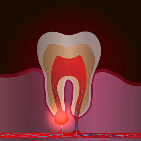 My Toothache Disappeared — What Does That Mean?